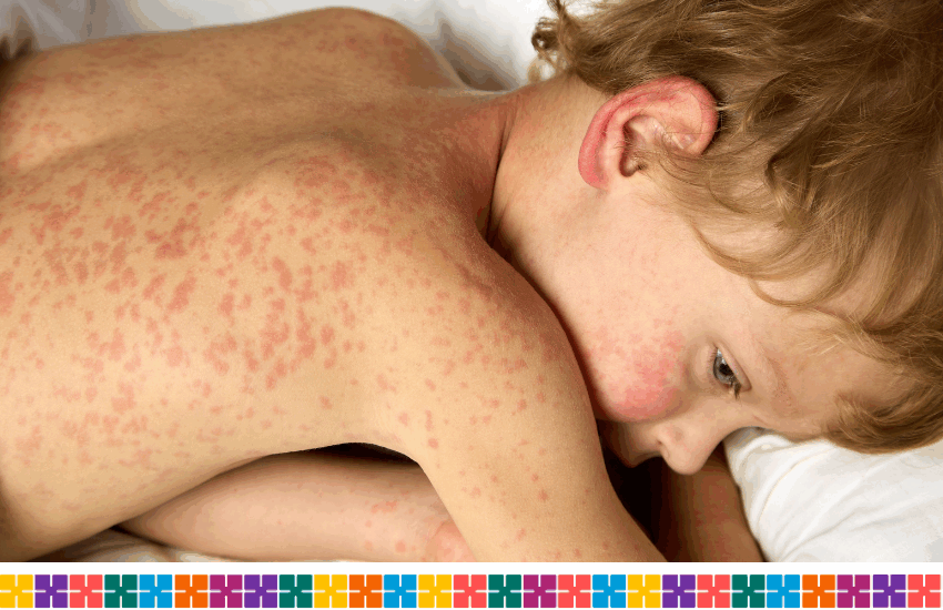 Young blonde boy aged around 7 lying on his front with a red rash all over his back and arms